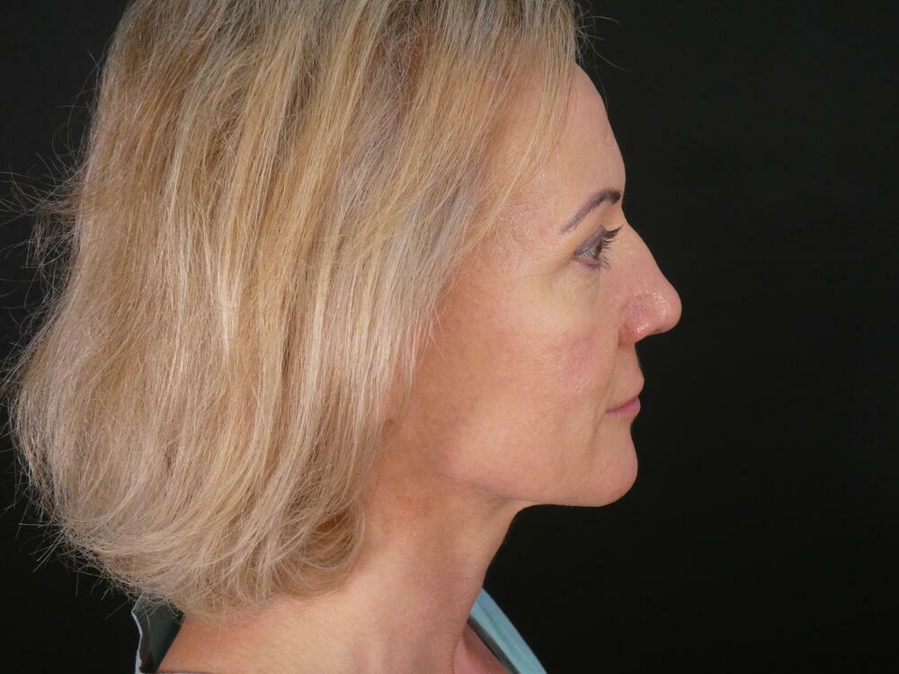 Rhinoplasty  Before & After