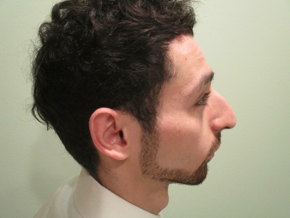 Rhinoplasty  Before & After