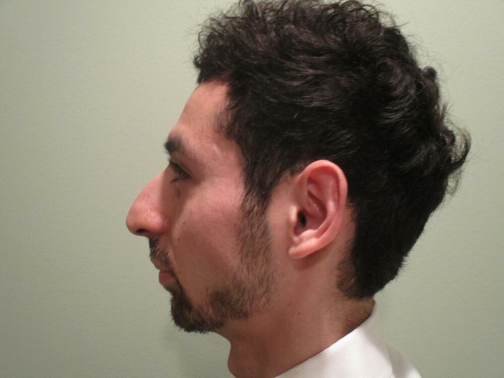 Rhinoplasty  Before & After