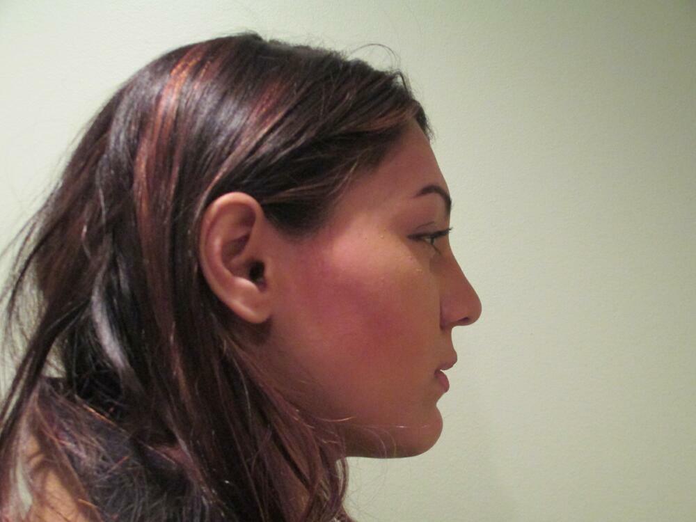 Rhinoplasty  Before & After