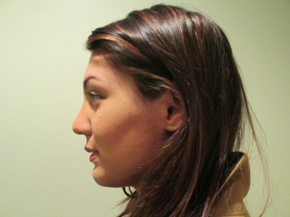 Rhinoplasty  Before & After