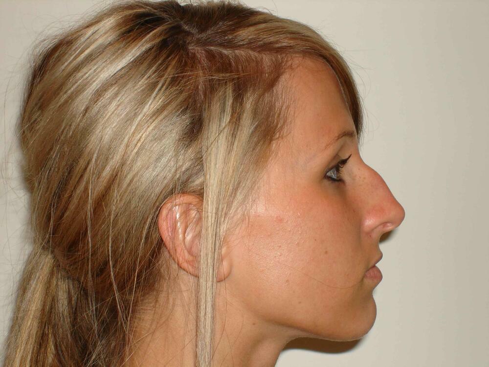 Rhinoplasty  Before & After