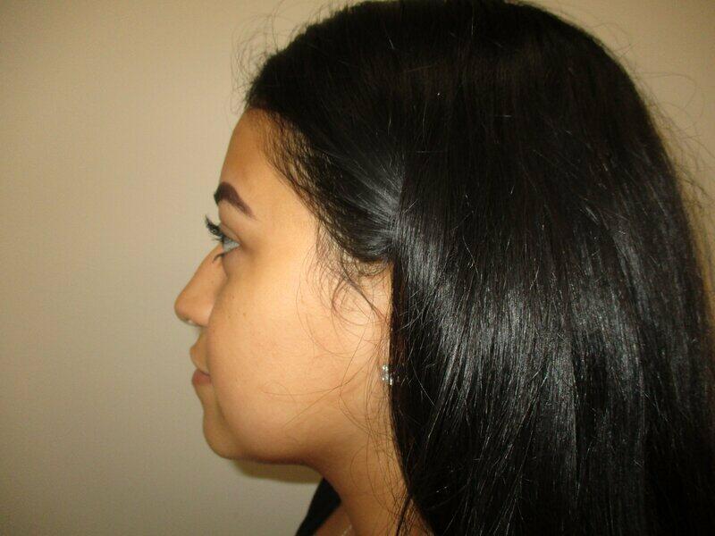 Rhinoplasty  Before & After