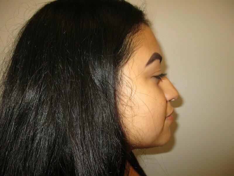 Rhinoplasty  Before & After