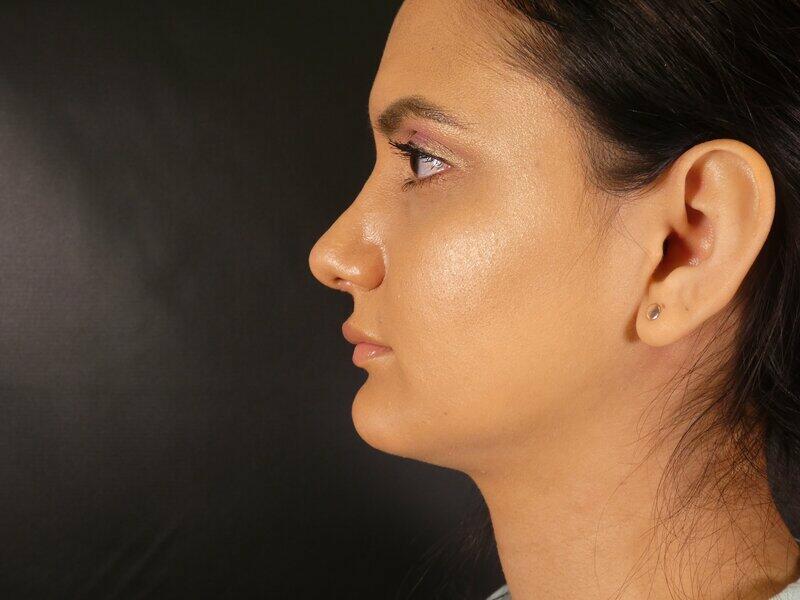 Rhinoplasty  Before & After