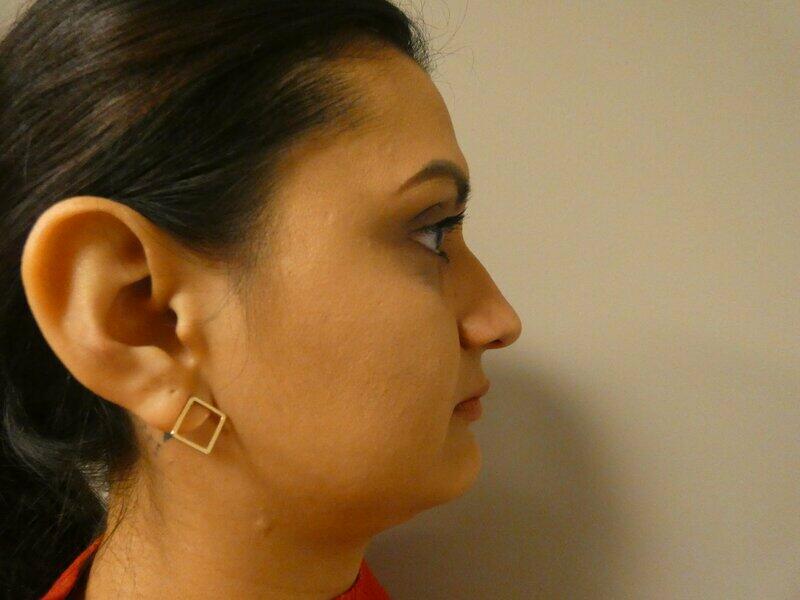 Rhinoplasty  Before & After