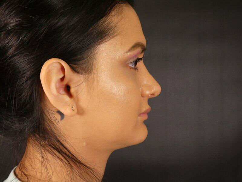 Rhinoplasty  Before & After